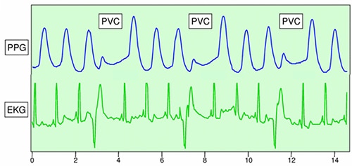 Electrocardiogram (EKG) compared to photoplethysmogram (PPG) Image of electrocardiogram (EKG) compared to photoplethysmogram (PPG)