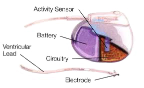 Image of In a traditional pacemaker design, the battery takes up a significant area of the implantable device