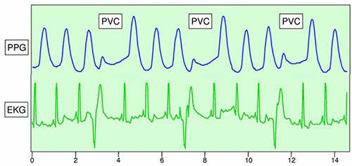 Image of electrocardiogram (EKG) compared to photoplethysmogram (PPG)