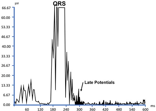 Graph of ECG results occur during the QRS complex