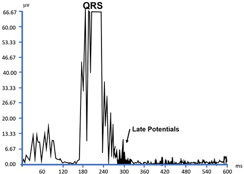 QRS 波群期间出现的 ECG 结果图